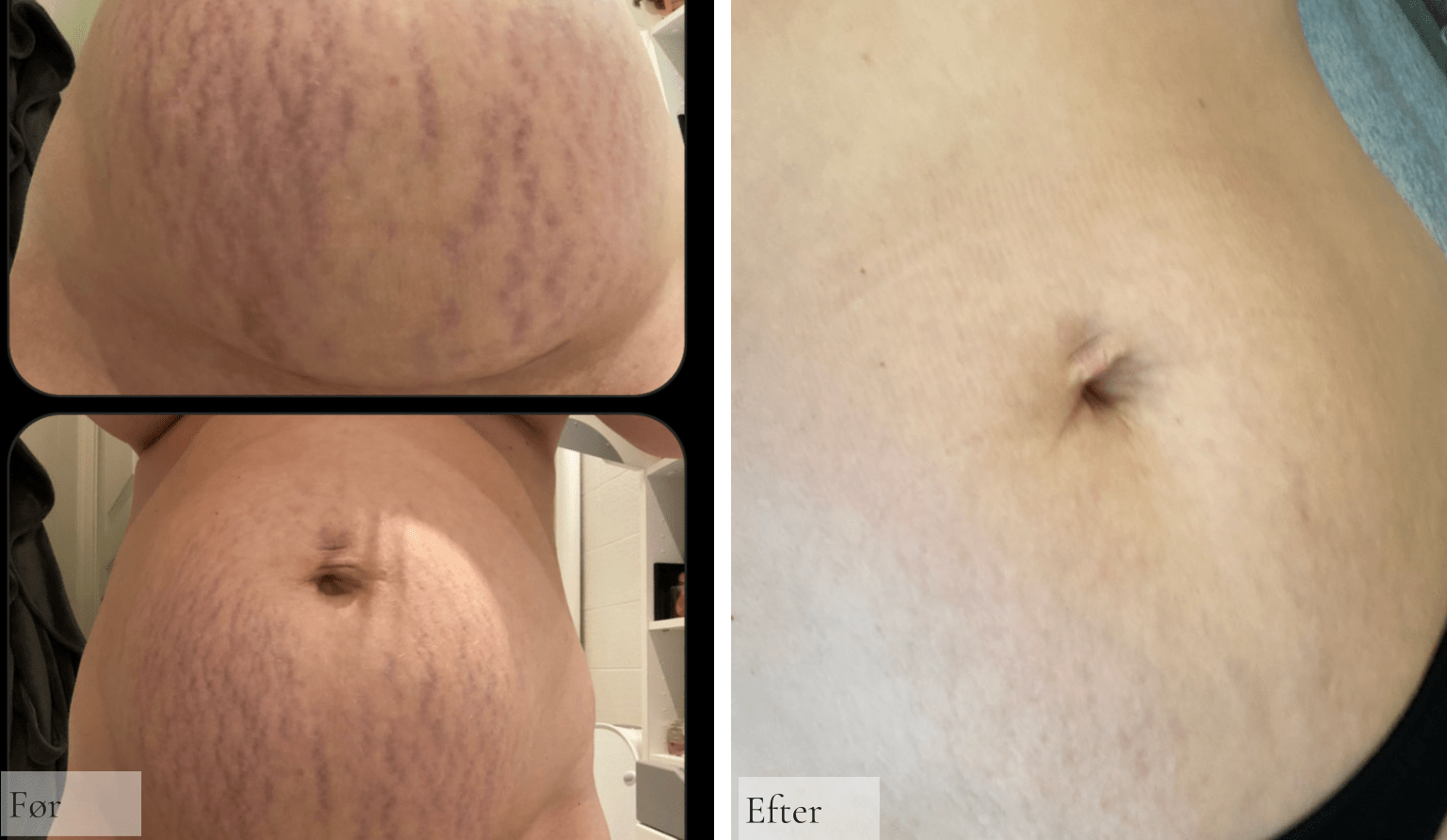 Hudpleje ved overvægt – forstå huden og giv den, hvad den har brug for - Raz Skincare