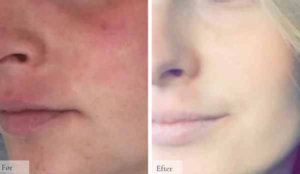 Atopisk dermatitis