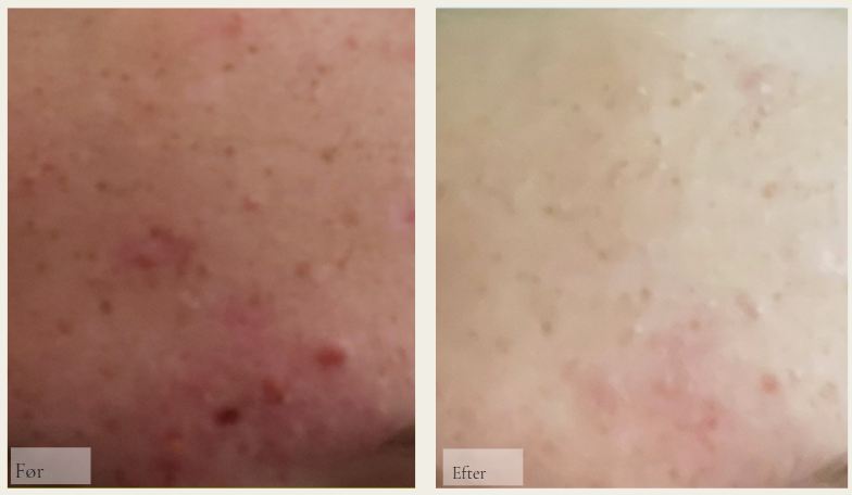 Blackheads