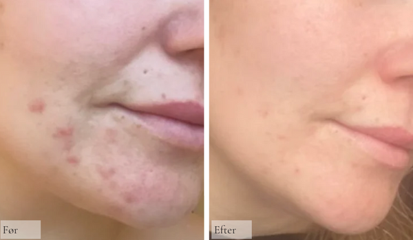 Perioral dermatitis