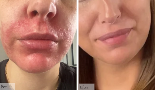 Perioral dermatitis 
