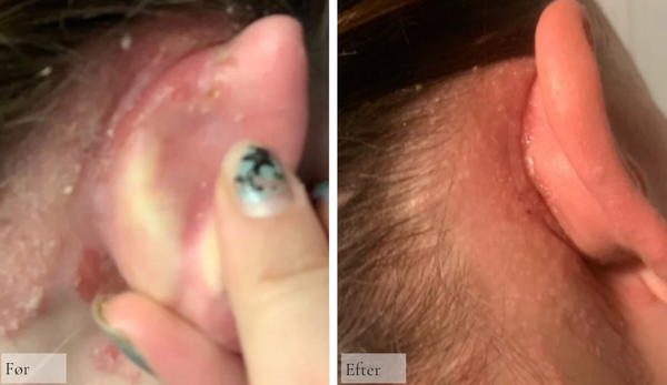 Psoriasis bag øret og i hovedbunden