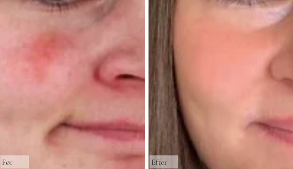 Rosacea