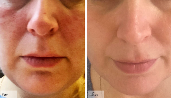 Rosacea