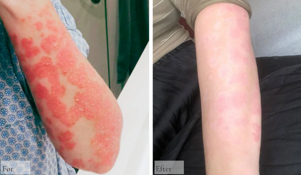 Psoriasis på armen
