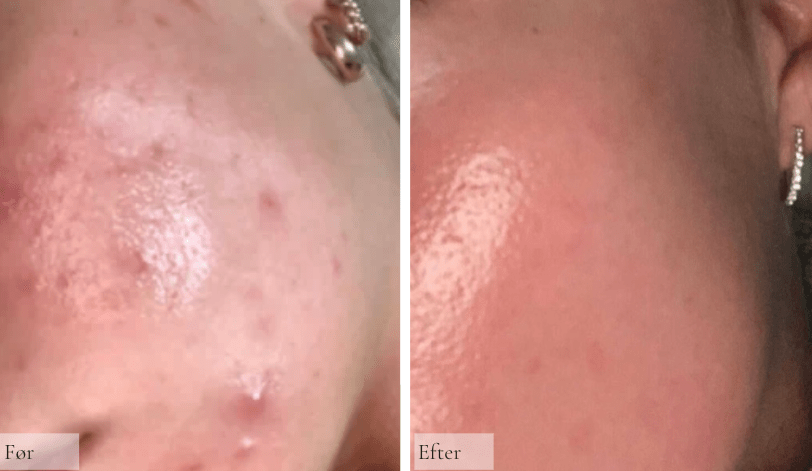 Akne Vulgaris/uren hud - Raz Skincare