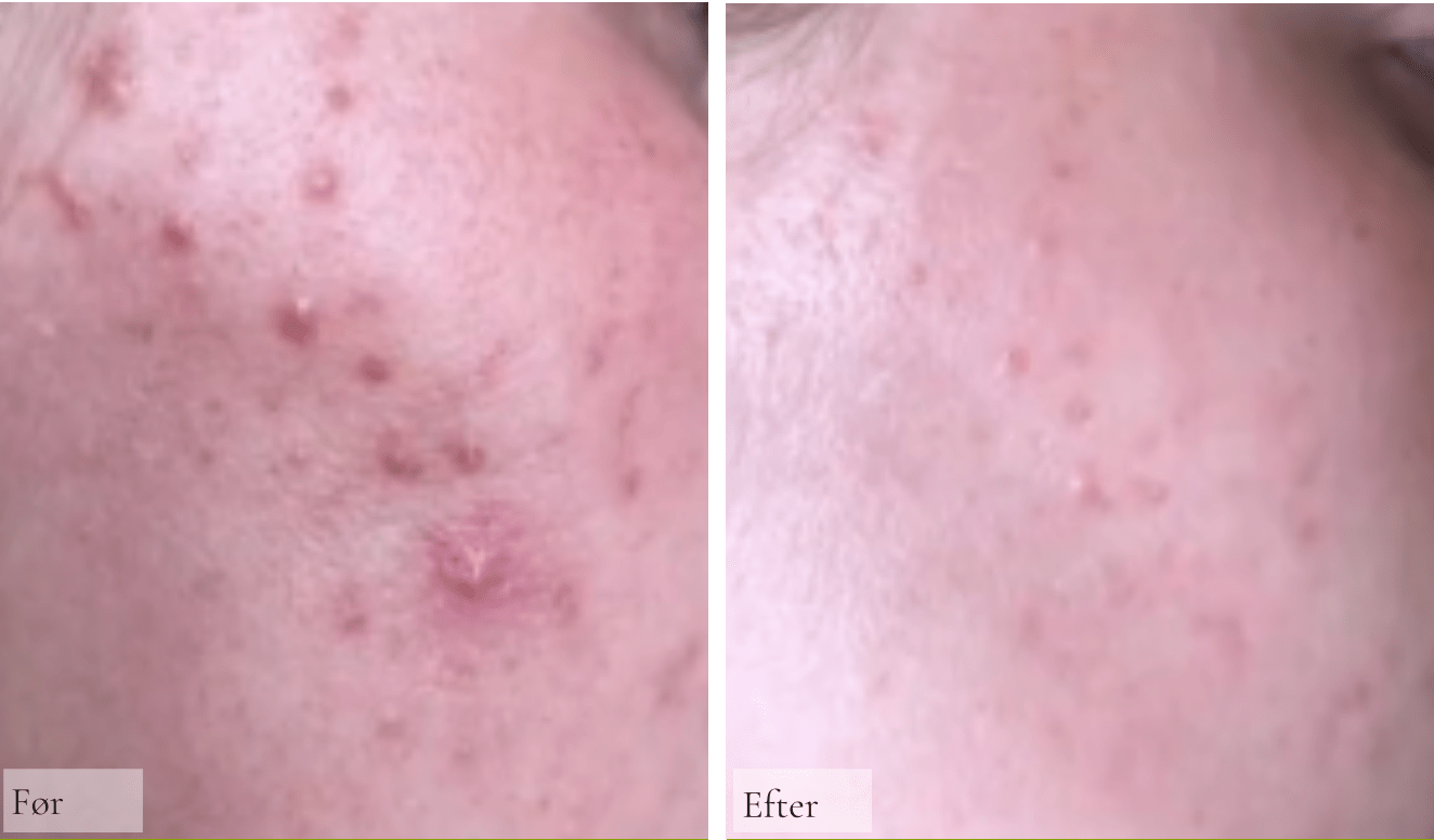 Breakout Skin Kit - Raz Skincare