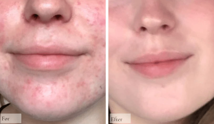 Perioral Dermatitis - Raz Skincare