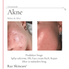 Før og efter billeder af en kundes kind med akne, ved brug af Repair SPF30, Hh og Rich. Venstre: Før Højre: Efter