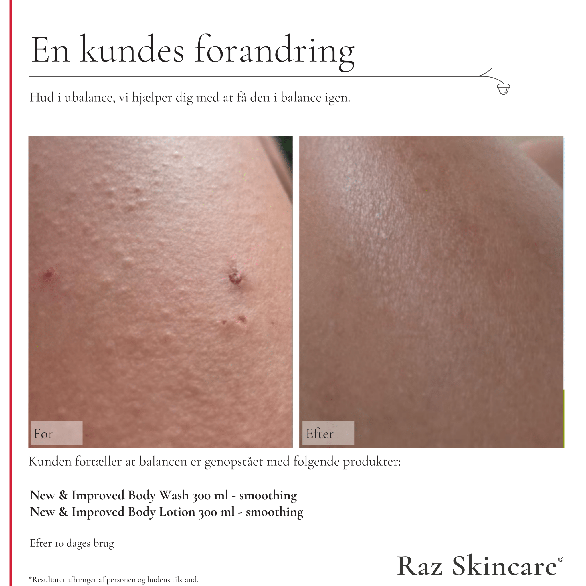 Før og efter billeder af en kundes ben, hvor der er afhjulpet jordbær ben efter brug af Body wash og lotion fra Raz Skincare