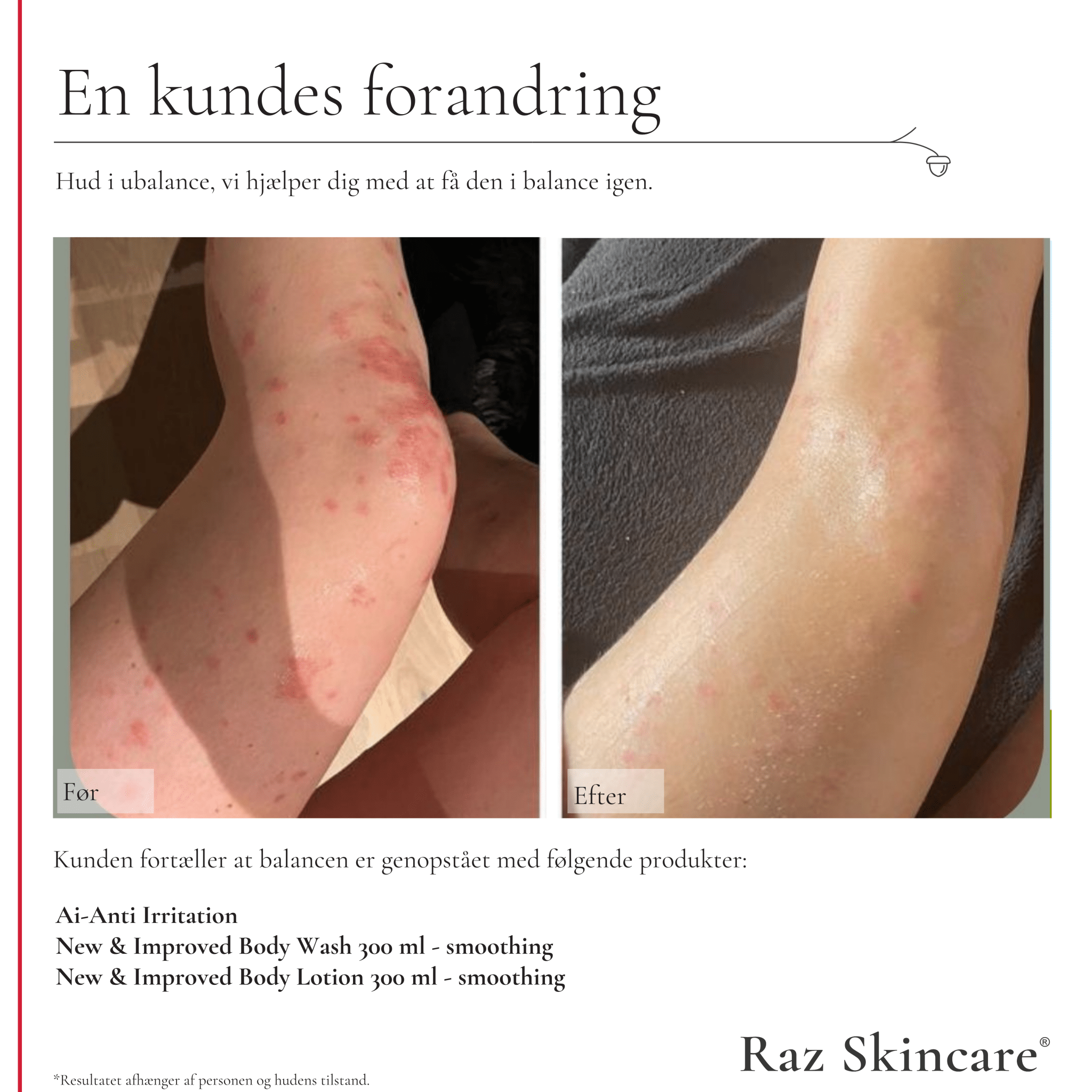 Før og efter billede af en kundes ben med keratosis pilaris, efter brug af body wash, lotion og Cp fra Raz Skincare