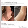 Før og efter billede af en kundes ben med keratosis pilaris, efter brug af body wash, lotion og Cp fra Raz Skincare